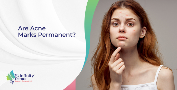 Are Acne Marks Permanent?