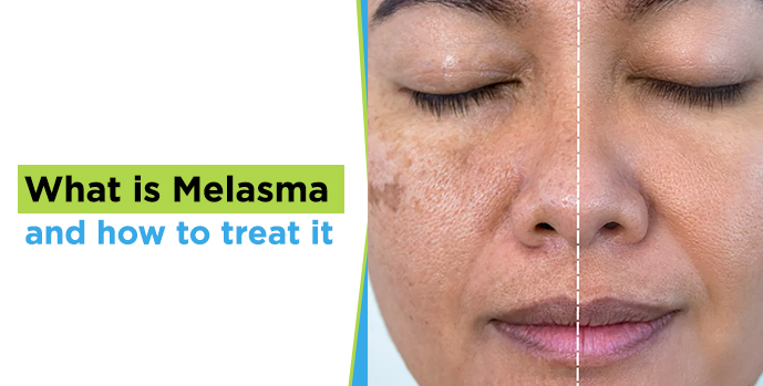 melasma 