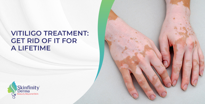 VITILIGO TREATMENT