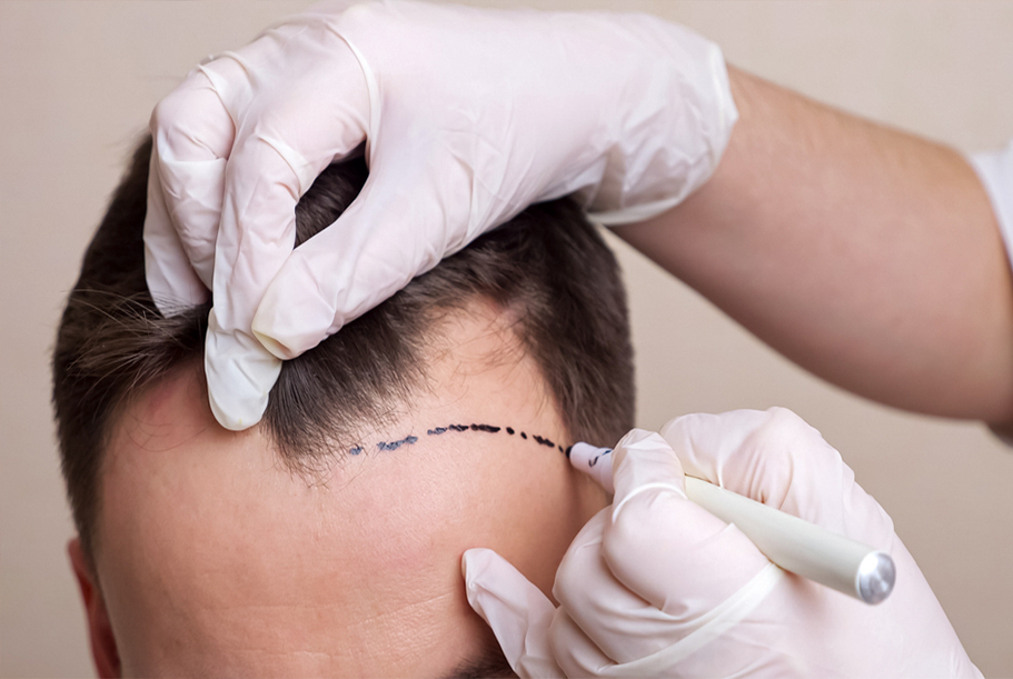 Best Hair Transplant in Delhi  FUE Hair Transplant Cost  NHT India